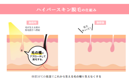 ケノン 脱毛器 白く ハイパースキン脱毛